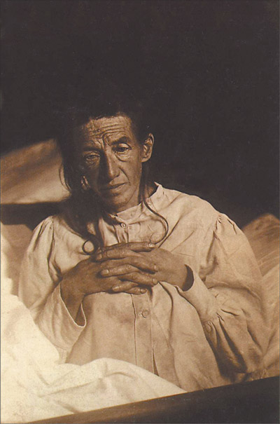 Auguste Deter, patiente d'Aloïs Alzheimer (1902)